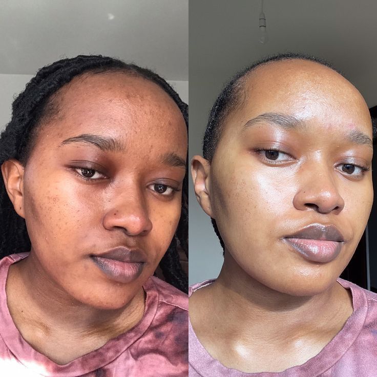 Before and after skin transformation