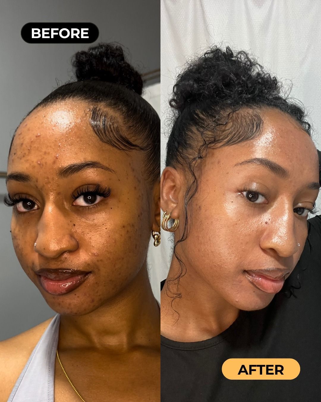 Before and after skin transformation